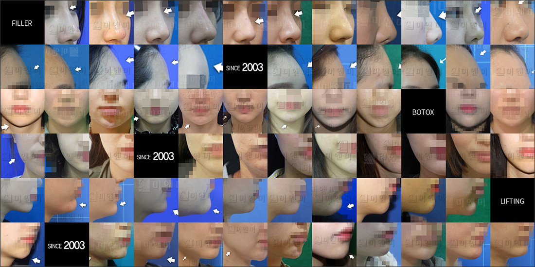 SINCE 2003 MI&MI, 시술후사진모음 강남피부과-강남역피부과 아름다움을 드리는 자신감 강남피부과 미앤미