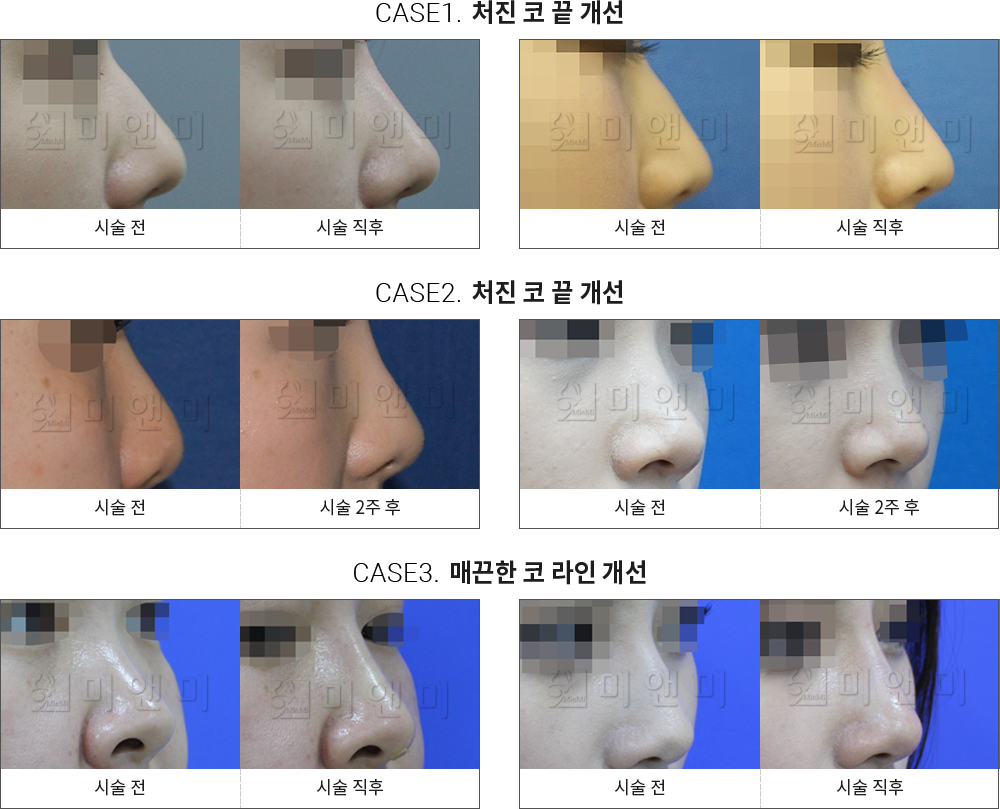 시술전후사진 미앤코 : 처진 코 끝 개선, 매끈한 코라인 개선 